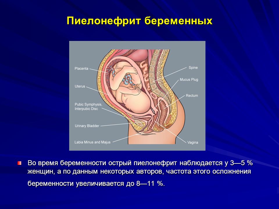 Пиелонефрит при беременности